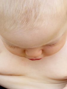 obesità infantile